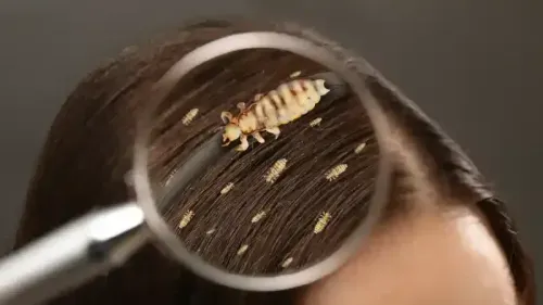 What are the Most Effective Ways to Eliminate Head Lice?
